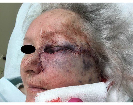 Basosquamous Carcinom | Case of the Month | Pine Belt Dermatology