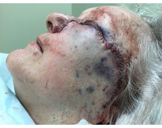 Basosquamous Carcinom | After Surgery | Pine Belt Dermatology