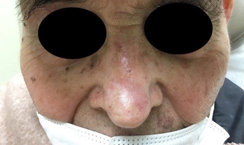 Completely Healed Basal Cell Carcinoma | Pine Belt Dermatology