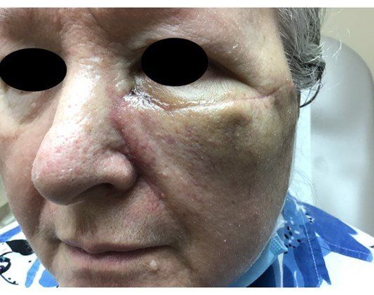 Basosquamous Carcinom Healing Process | Pine Belt Dermatology