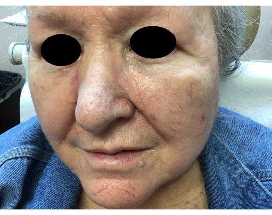 Basosquamous Carcinom Healed | Pine Belt Dermatology