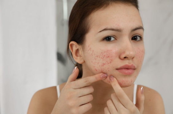 Psoriasis During the Winter Season | Pine Belt