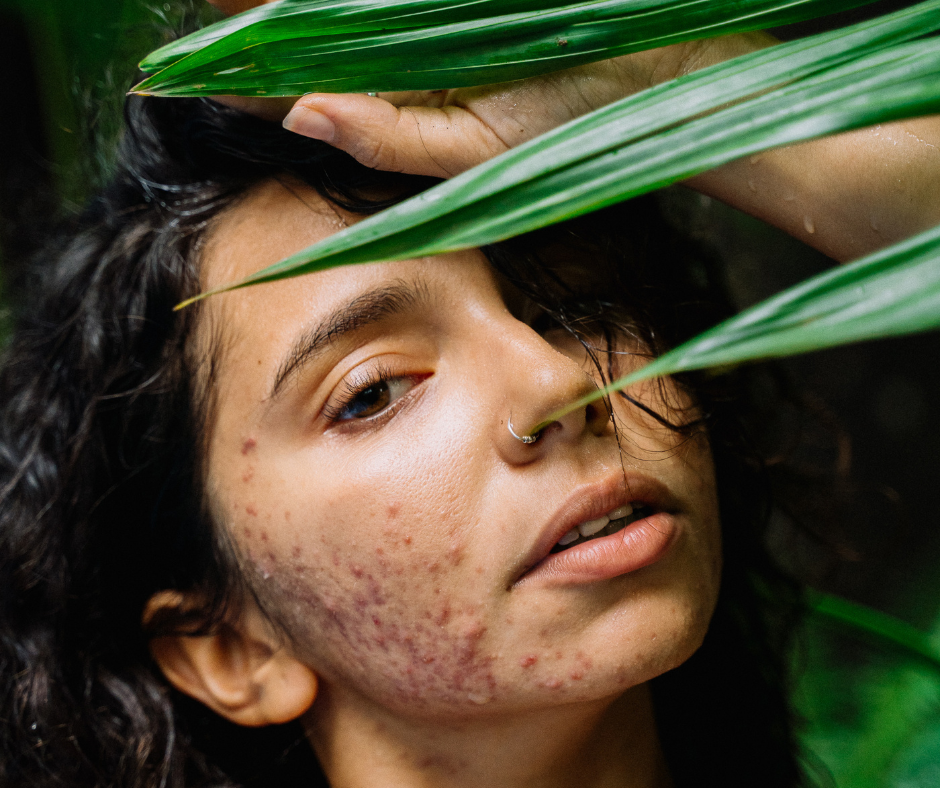 Heat and Acne | Pine Belt Dermatology Heat and Acne | Pine Belt Dermatology
