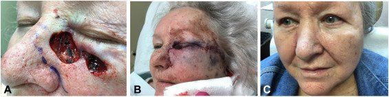 Primary Nasal Sidewall | Pine Belt Dermatology