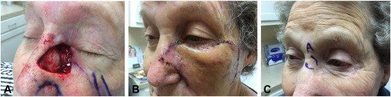 Mustarde Flap for Primary Nasal Sidewall | Pine Belt Dermatology