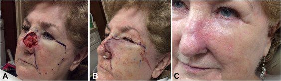 Mustarde Flap | Pine Belt Dermatology