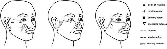 Mustarde Flap Diagram | Pine Belt Dermatology