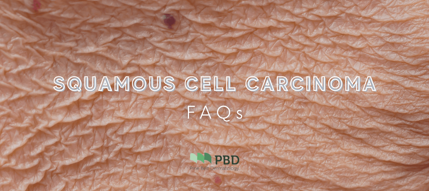 Frequently Asked Questions about Squamous | Pine Belt Dermatology