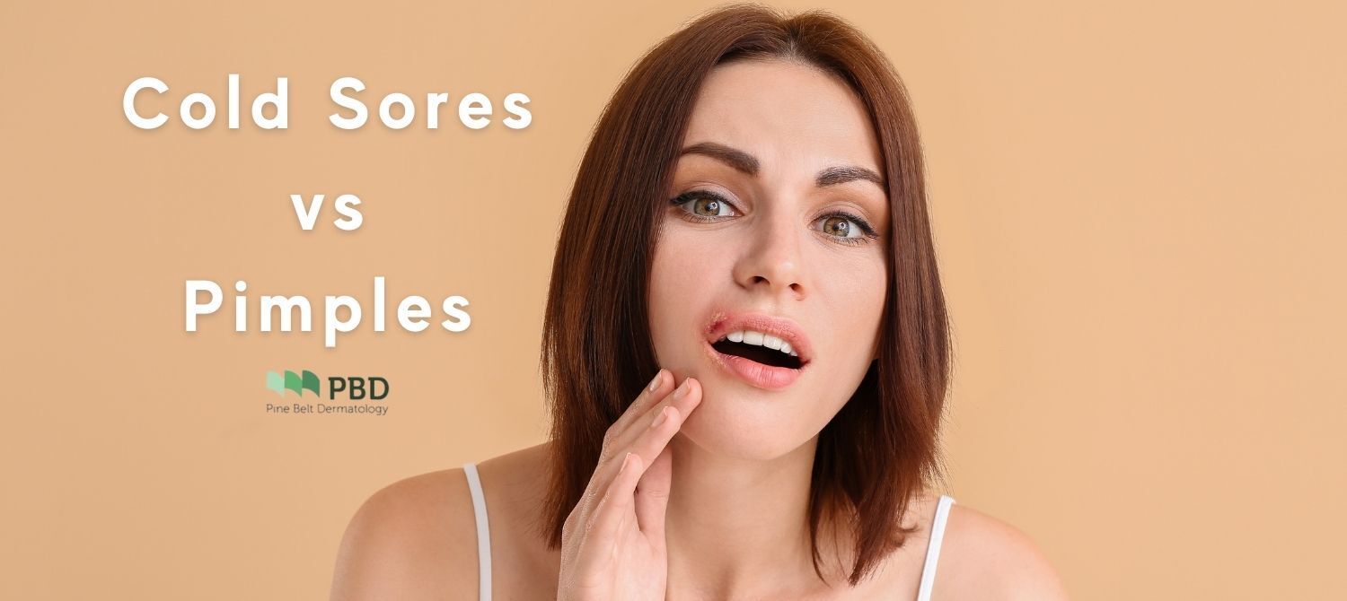 Cold Sores vs. Pimples | Pine Belt Dermatology