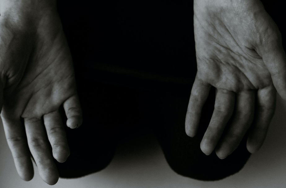 Psoriasis in People of Color | Pine Belt Dermatology