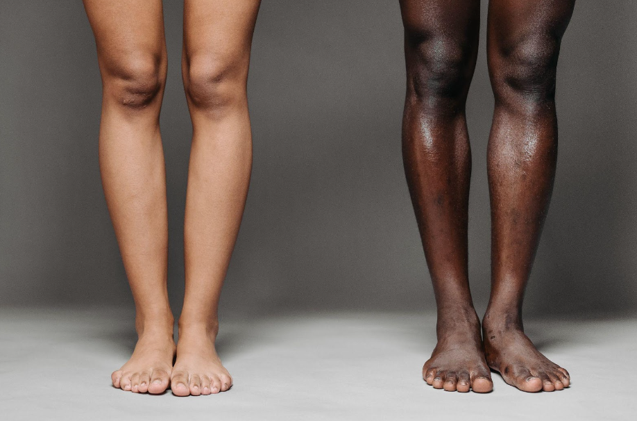 sclerotherapy