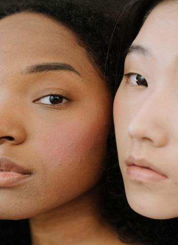 Milia | Pine Belt Dermatology