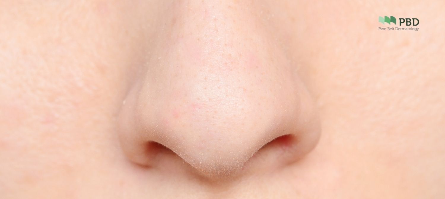 Bilateral Superiorly | Pine Belt Dermatology
