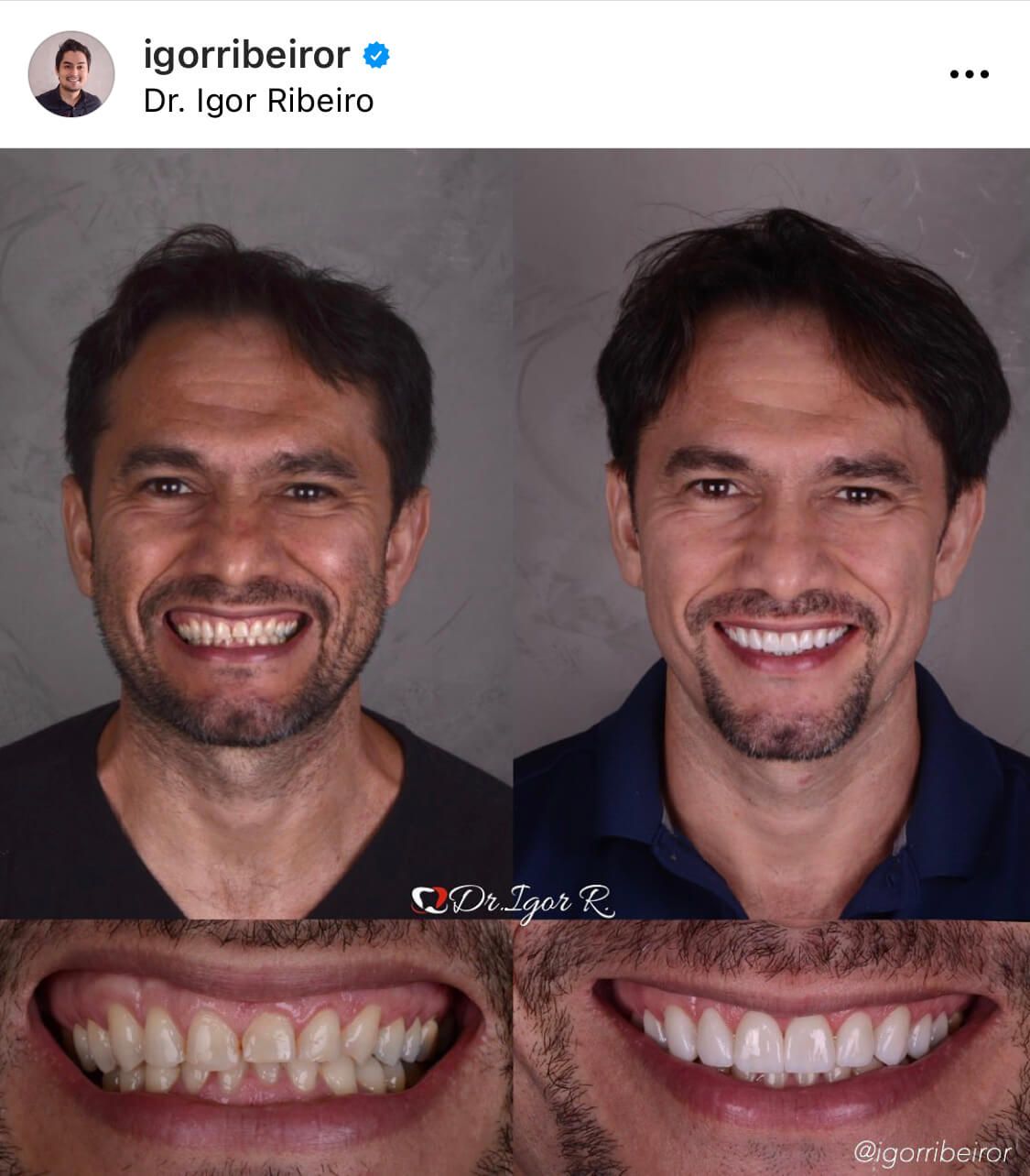 Antes y después de un tratamiento dental. Hombre sonriendo; sus nuevos dientes son blancos.