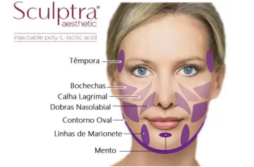 Diagrama de um rosto com marcações roxas indicando as áreas para injeções de Sculptra. Legendas em português.