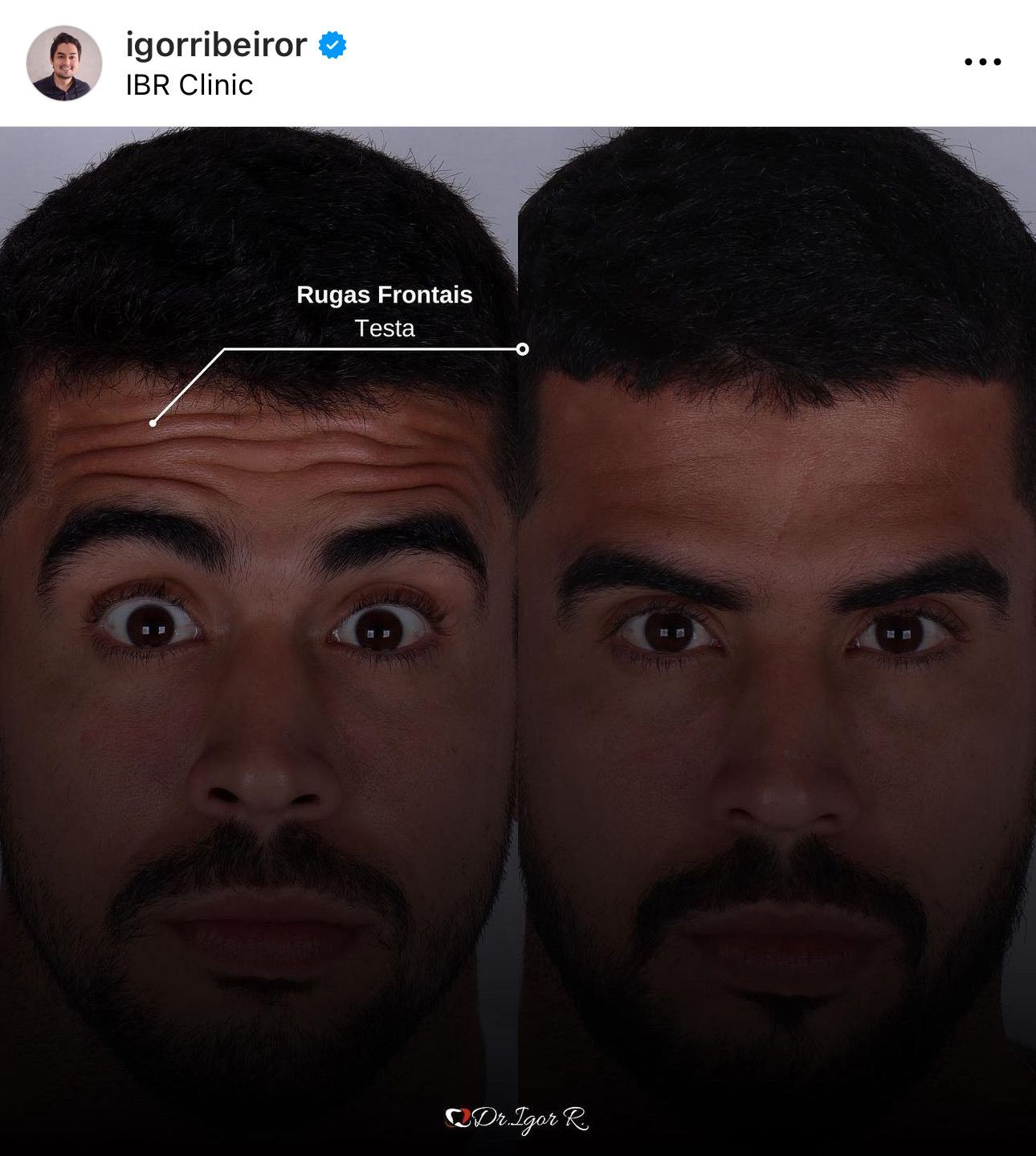 Fotos de antes e depois de um homem; à esquerda, rugas na testa; à direita, pele mais lisa.