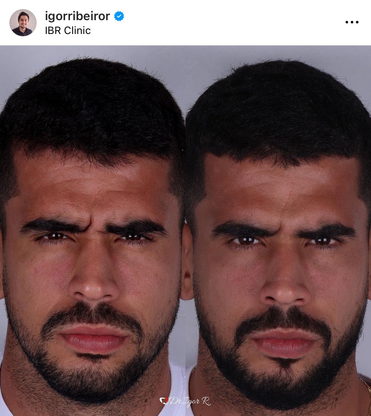 Fotos lado a lado de um homem antes e depois de um procedimento, mostrando mudanças em sua testa, barba e estrutura facial em geral.
