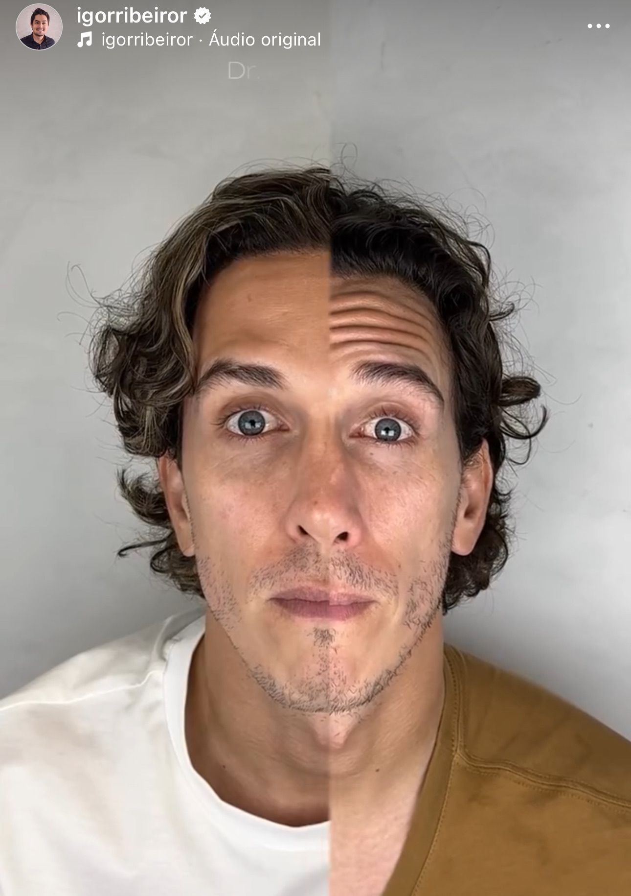 Rosto masculino dividido verticalmente; lado esquerdo pálido, lado direito bronzeado. Cabelo encaracolado, olhos arregalados.