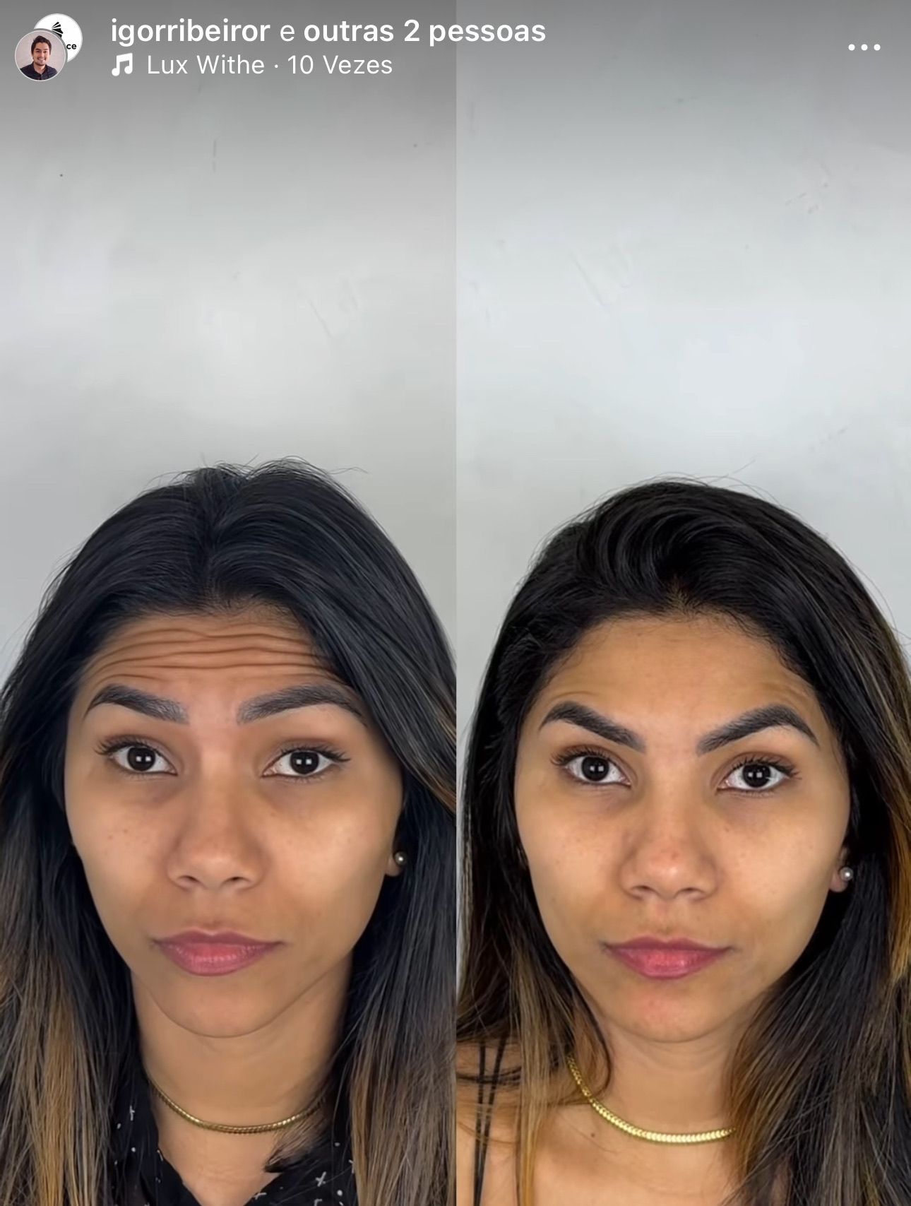 Comparação lado a lado do rosto de uma pessoa. À esquerda, rugas na testa; à direita, pele lisa. Retrato em tela dividida: Homem com um lado do rosto mais claro que o outro. Harmonização Facial Fortaleza