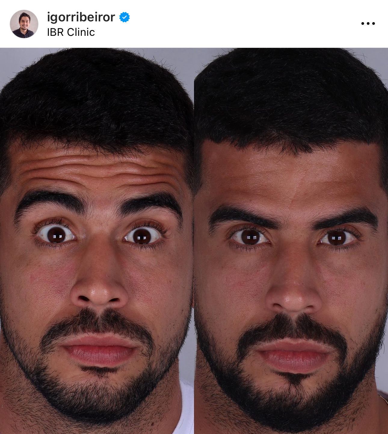 Comparação lado a lado do rosto de um homem antes e depois de um procedimento estético. As expressões mostram surpresa e compostura.