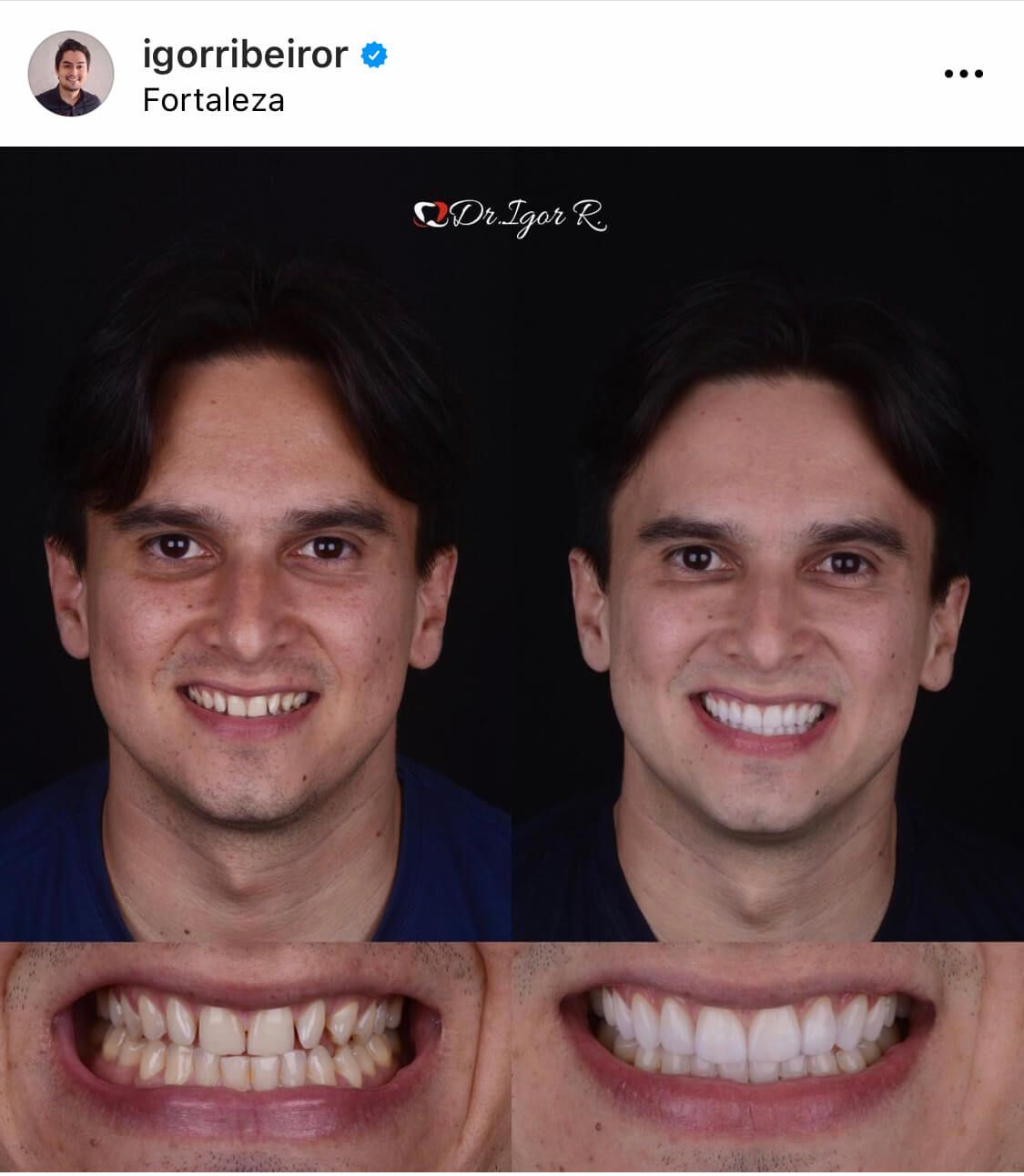 Fotografías comparativas del rostro y los dientes de un hombre: antes y después de un tratamiento dental. El hombre sonríe y sus dientes se ven más blancos.