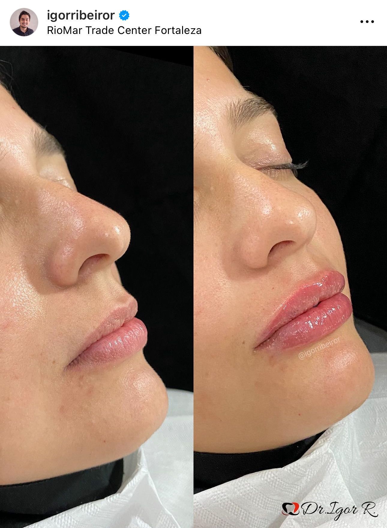 Antes e depois do tratamento com preenchimento labial no rosto de uma pessoa.