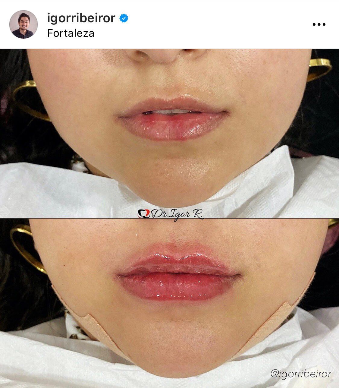 Deux photos des lèvres : avant et après injection d'acide hyaluronique.