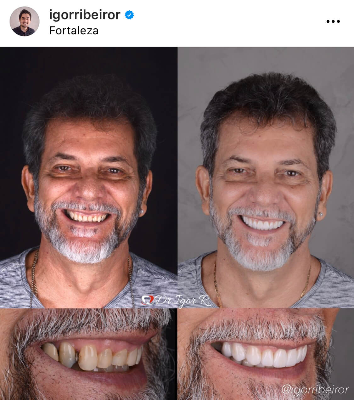 Fotos comparativas que muestran la sonrisa de un hombre antes y después de un tratamiento dental en Fortaleza. Dientes blanqueados y sonrisa mejorada.