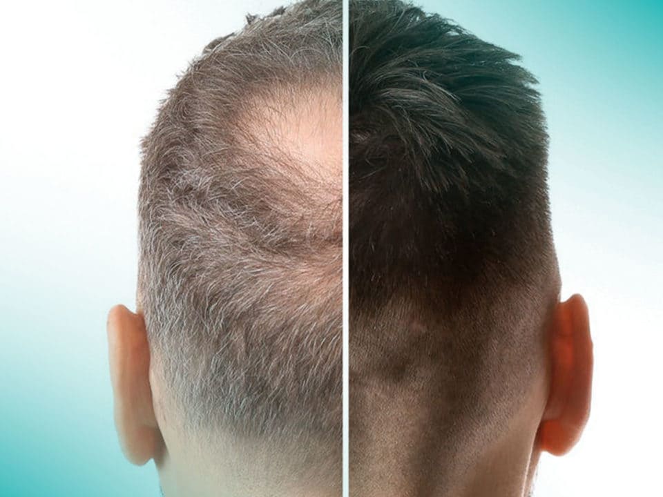 Hair loss comparison: Thinning, gray hair on left; thick, dark hair on right.