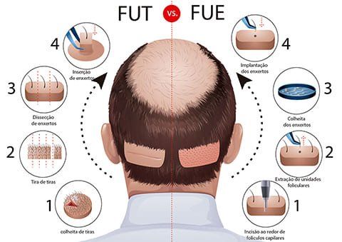 Comparison of FUT and FUE hair transplant methods.