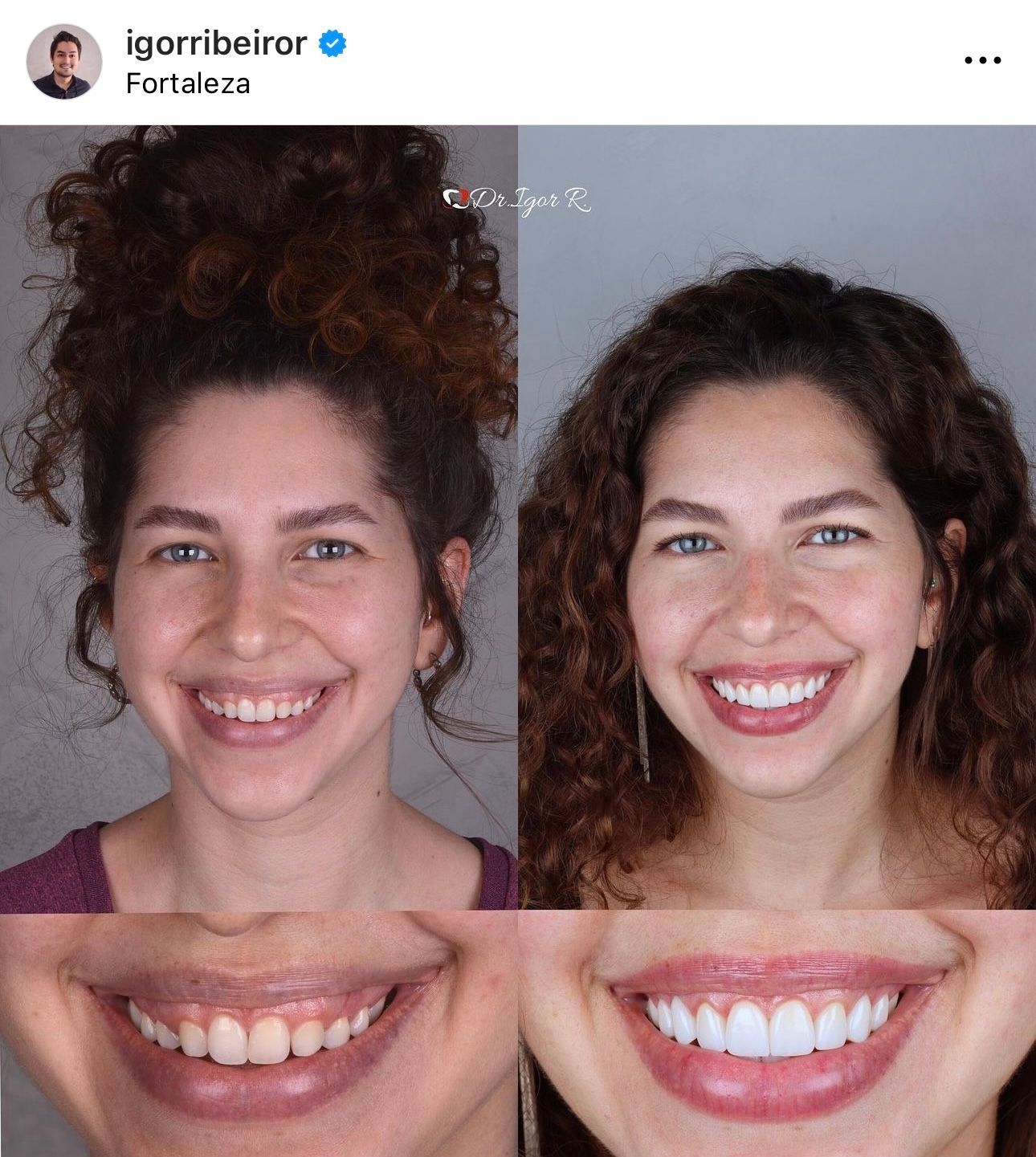 Antes e depois de um tratamento dentário. Mulher sorrindo. O lado esquerdo mostra os dentes originais. O lado direito mostra os dentes brancos e brilhantes.