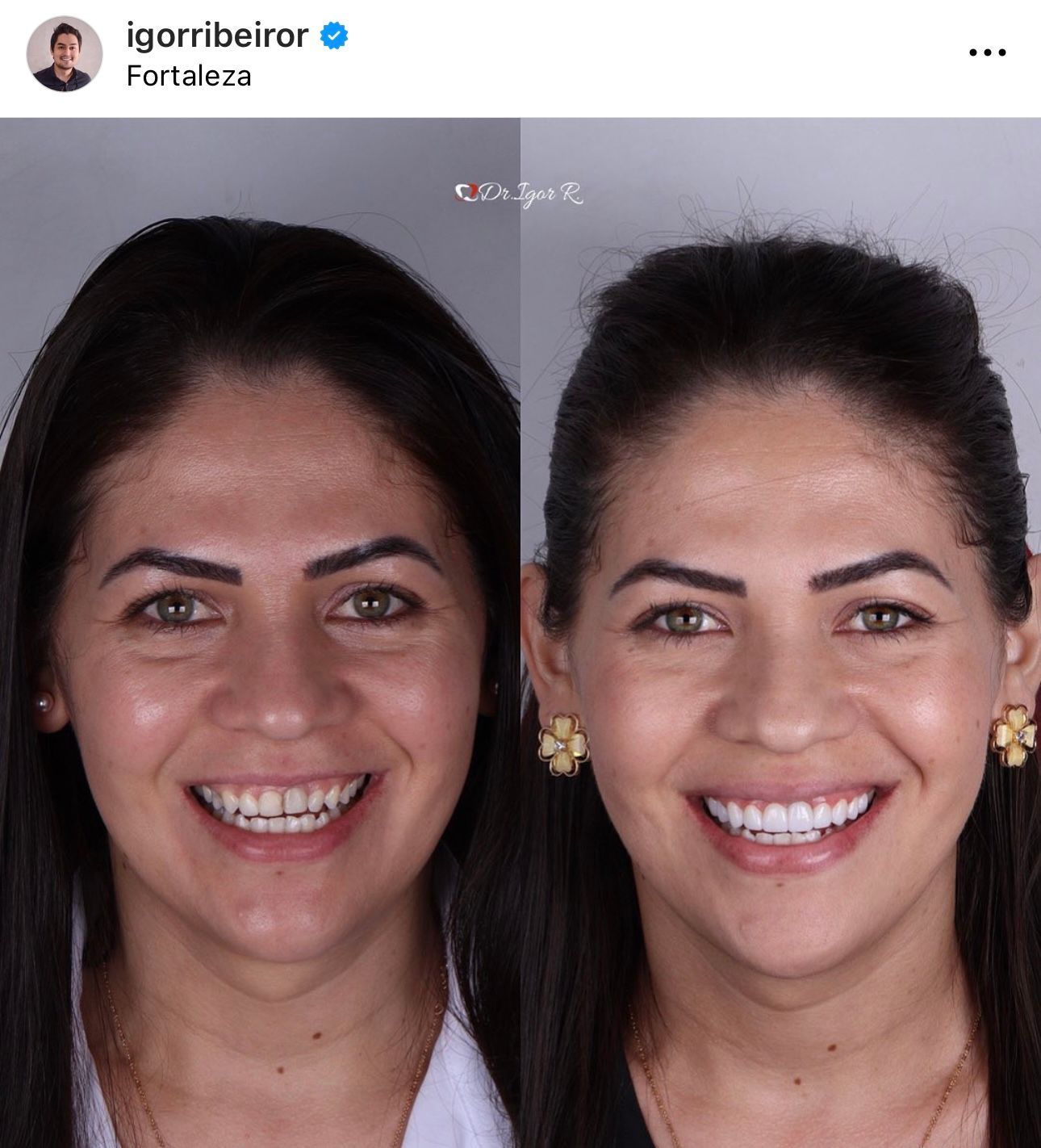 Fotos lado a lado de uma mulher sorrindo; antes do tratamento dentário (esquerda) e depois (direita), com dentes mais brancos.