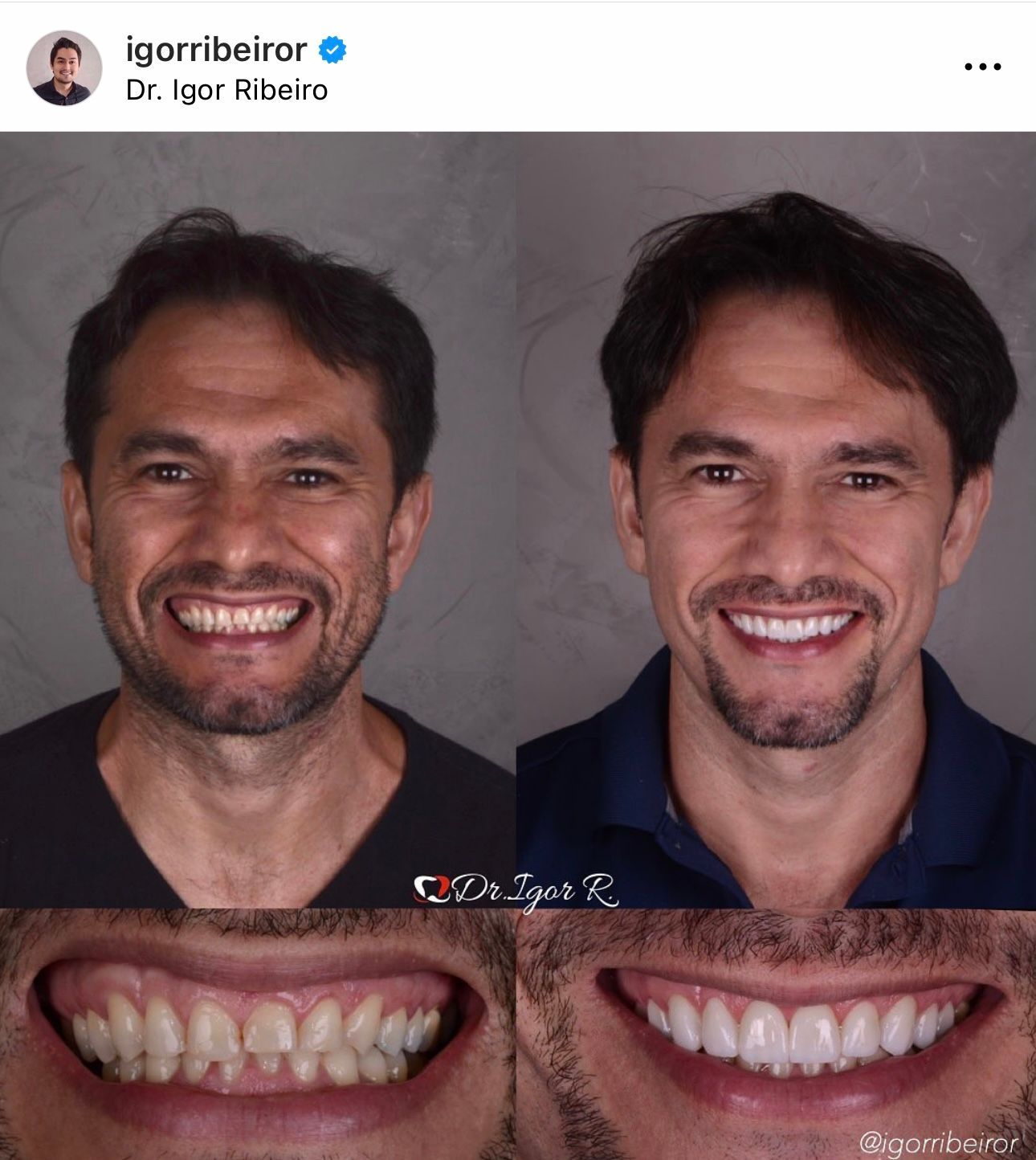 Fotos de antes e depois mostrando o clareamento dental. Homem sorrindo com dentes menos brancos e depois com dentes mais brancos.