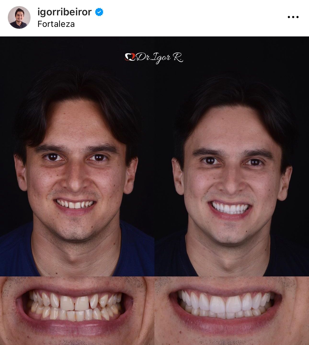 Antes e depois de um tratamento dentário: Homem sorrindo com os dentes originais e melhorados, fundo preto.