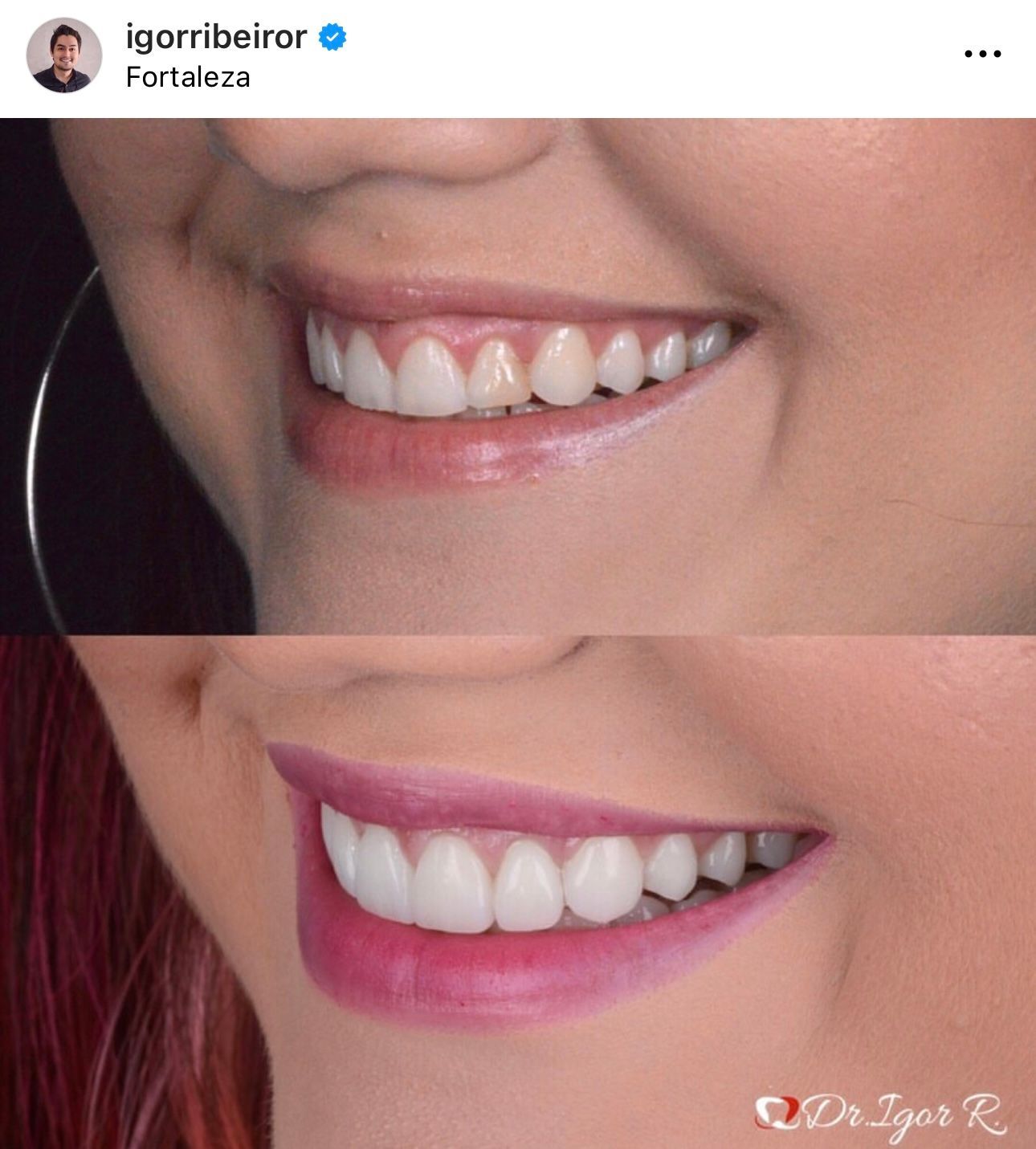 Antes e depois do sorriso de uma pessoa. A imagem de cima mostra um sorriso menos perfeito, enquanto a de baixo mostra um sorriso branco perfeito.