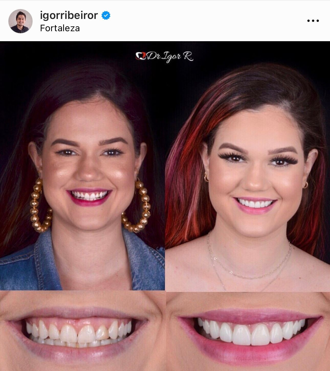 Antes e depois de um tratamento dentário: mulher sorrindo. Antes, dentes manchados; depois, dentes brancos e brilhantes.