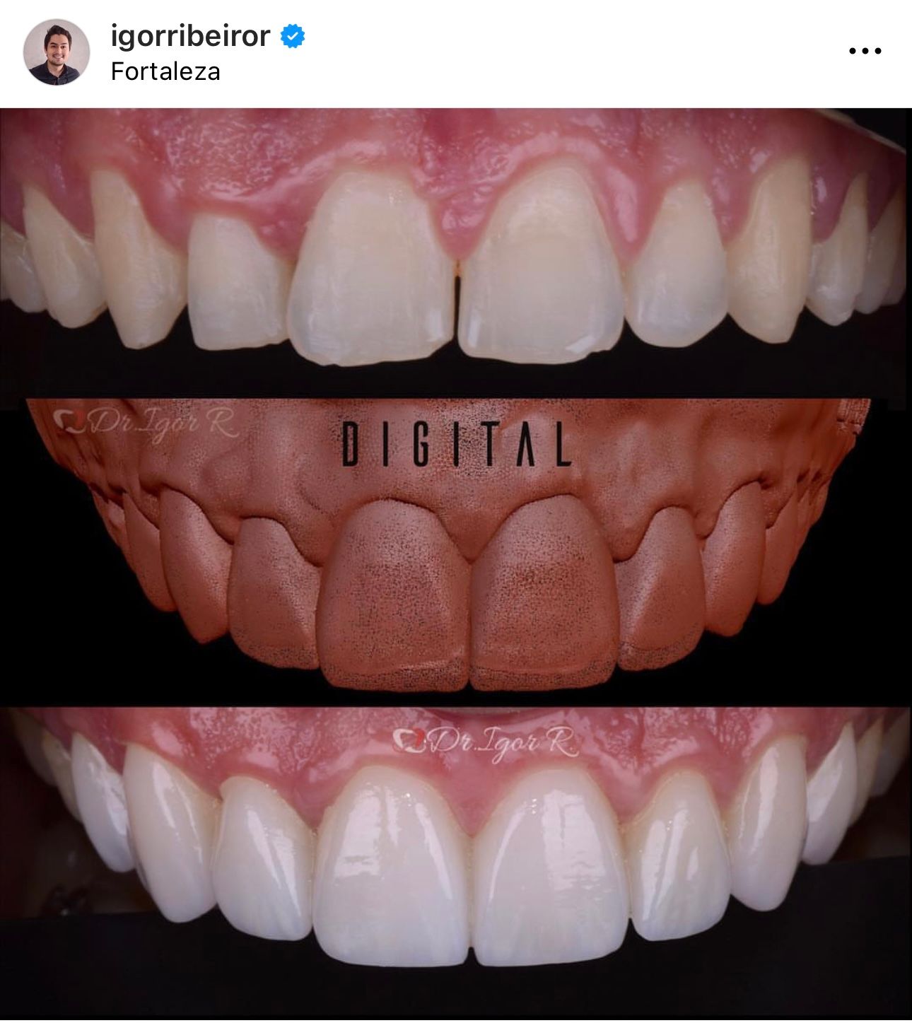 Transformação dentária: fotos de antes, modelo digital e depois de um procedimento odontológico para clarear os dentes.