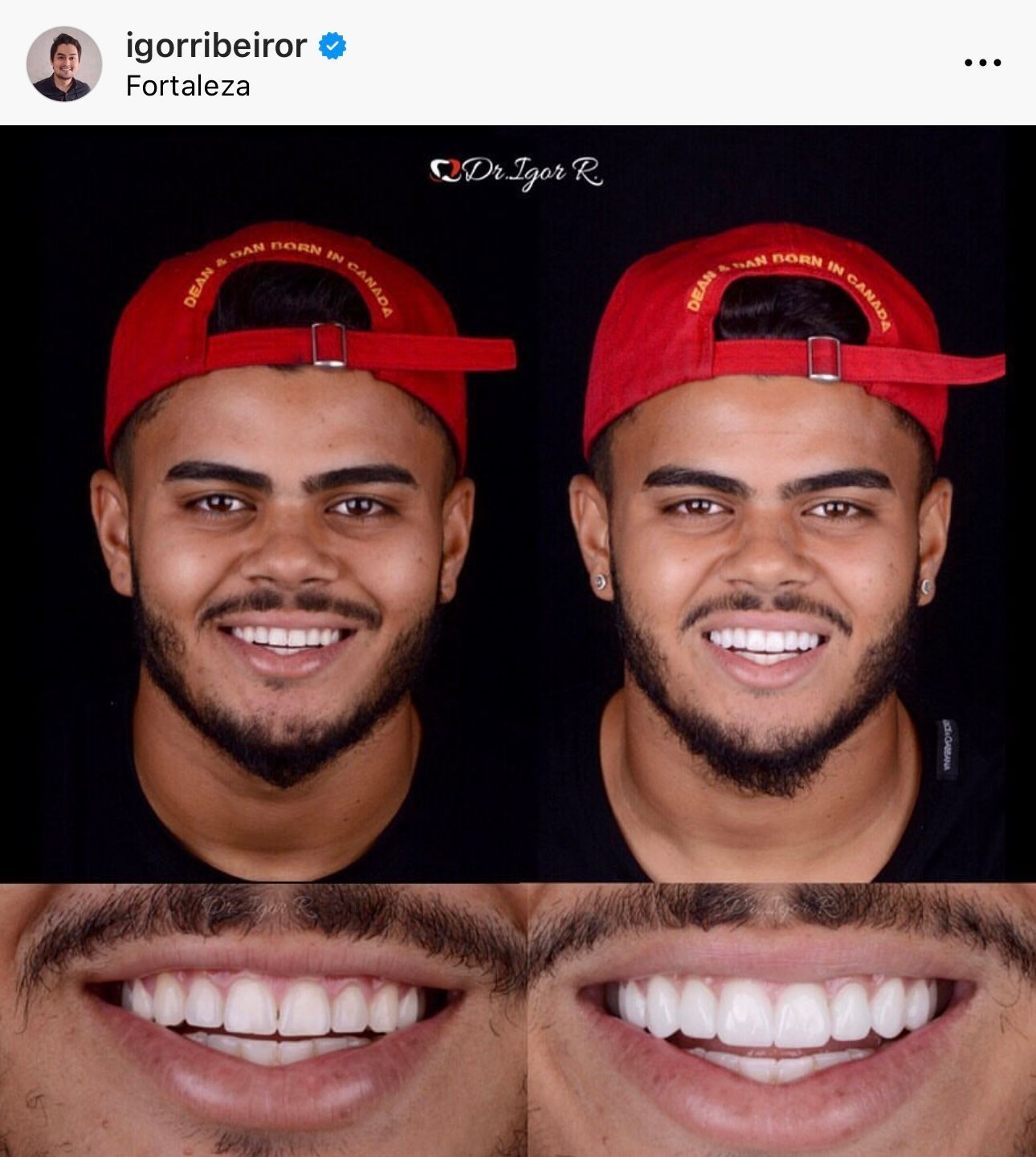 Comparação lado a lado do sorriso de um homem, antes e depois de um procedimento odontológico. Ele usa uma coroa vermelha; seus dentes parecem mais brancos.