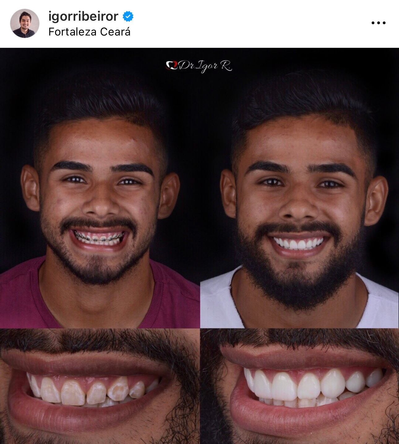 lente de contato dental jogador fortaleza felipe jonantan sorriso dentista dr igor ribeiro