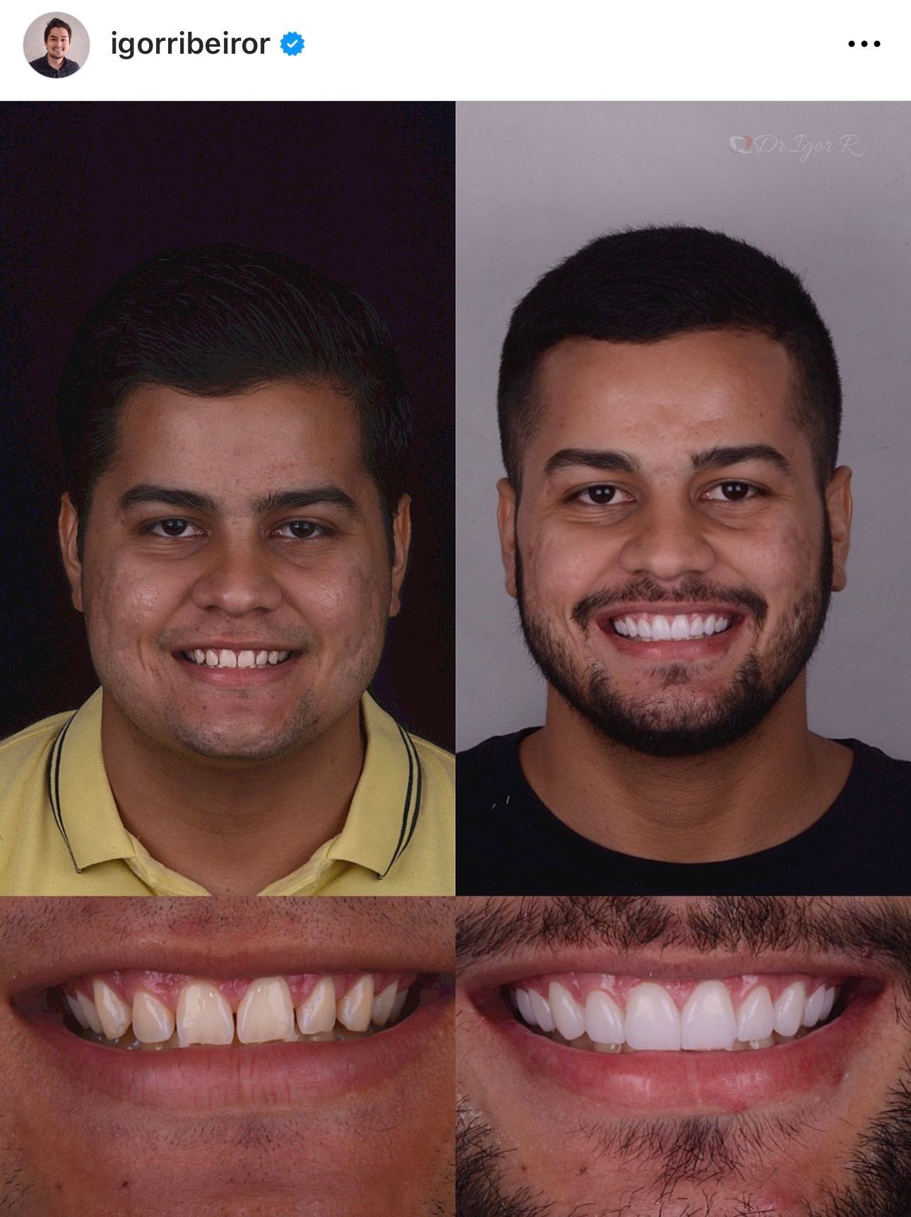 Antes e depois de um tratamento dentário. Homem com dentes manchados sorri à esquerda, enquanto à direita sorri com dentes brancos e brilhantes.
