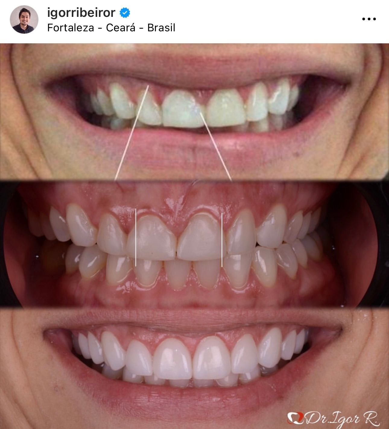 Três estágios da dentição: antes, durante e depois de um procedimento odontológico, com linhas indicando os ajustes.
