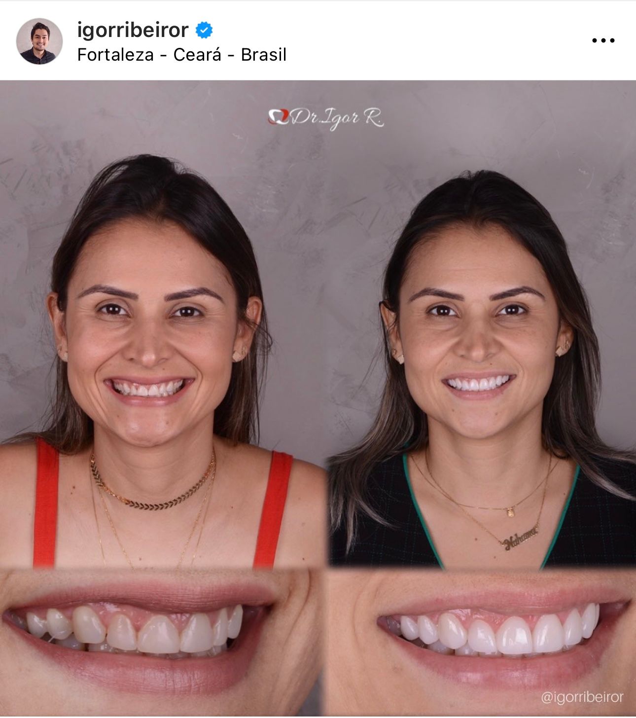 Antes e depois de um procedimento odontológico: mulher sorrindo. À esquerda, dentes originais. À direita, novas facetas. Fortaleza, Brasil.