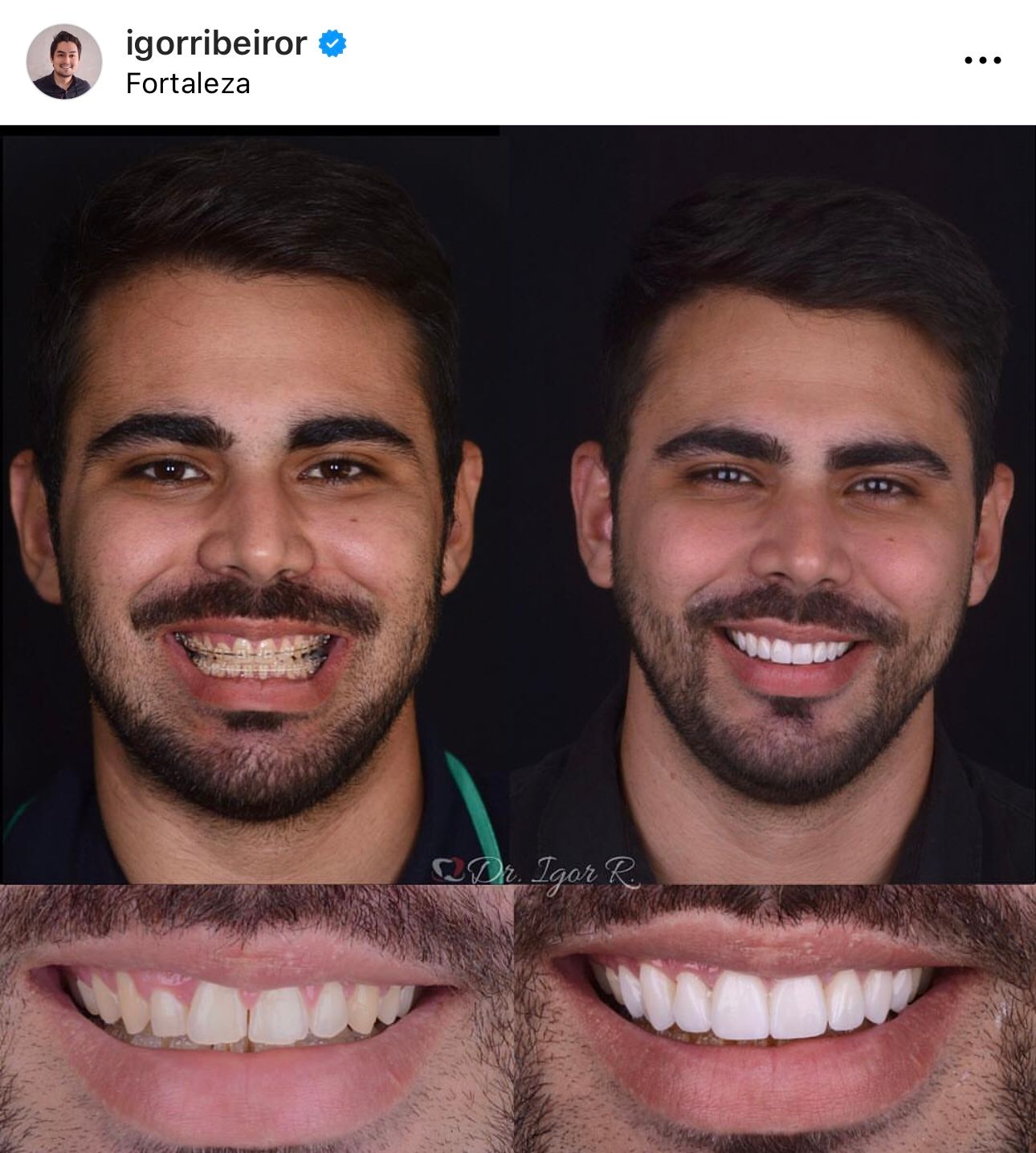 Fotos de antes e depois do sorriso de um homem; clareamento dental e aplicação de facetas.