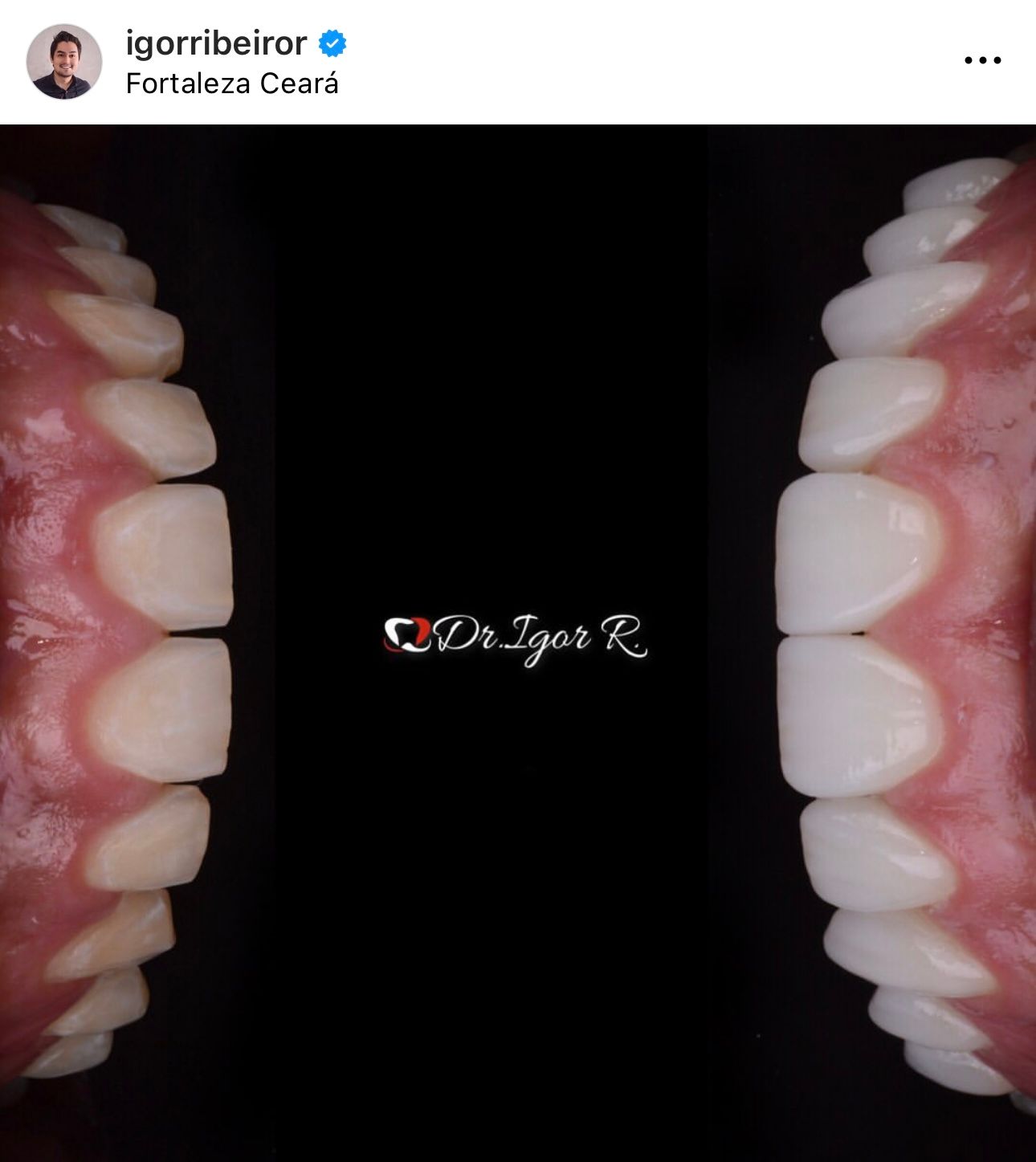 Duas fileiras de dentes, imagem espelhada, contra fundo preto. Dentes brancos e uniformes, gengivas rosadas, logotipo 