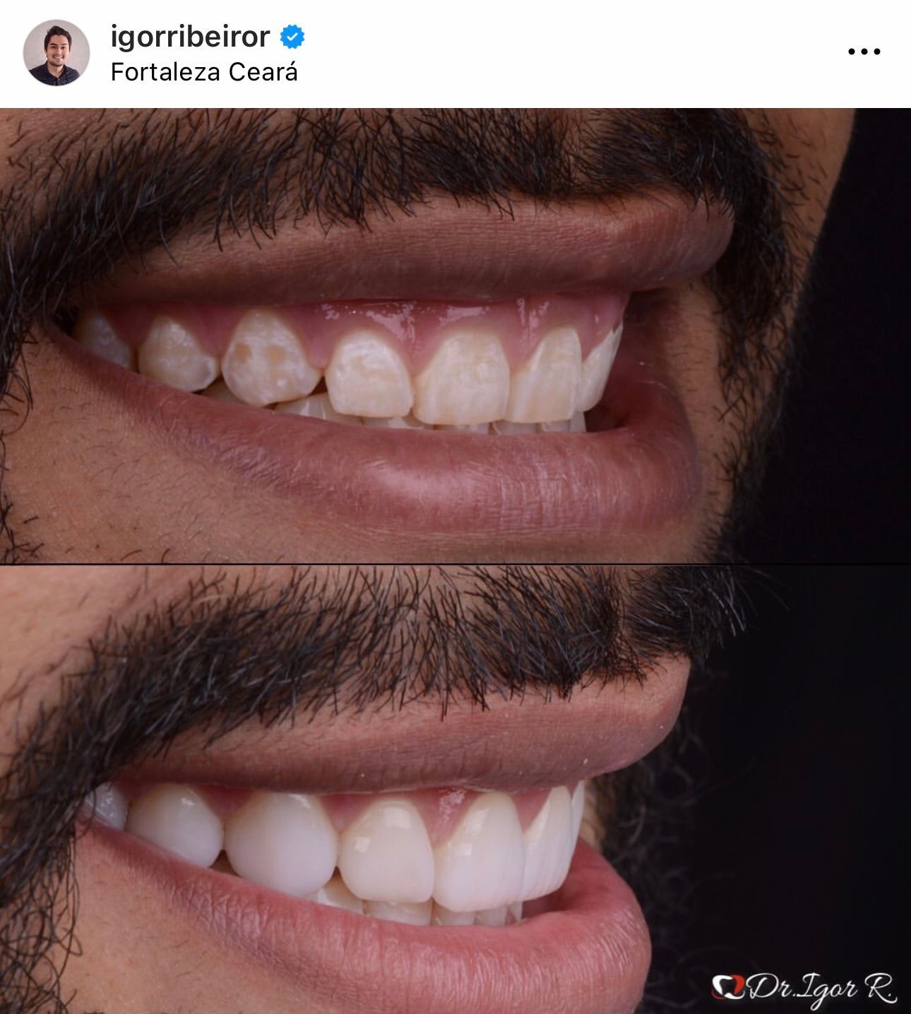 Comparação dos dentes de uma pessoa antes e depois de um procedimento odontológico estético; dentes brancos na foto do depois.