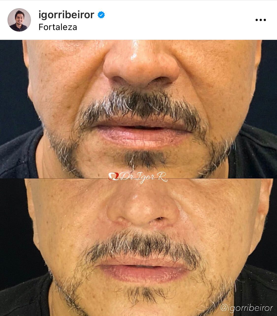 Comparação lado a lado do rosto de um homem antes e depois de um procedimento estético, com foco nos lábios e na área circundante.