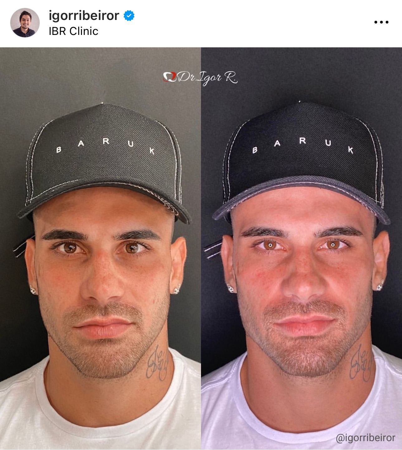 Fotos lado a lado de um homem usando chapéu. A foto da direita tem os traços faciais realçados.