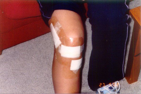 Post-op scars neatly bandaged