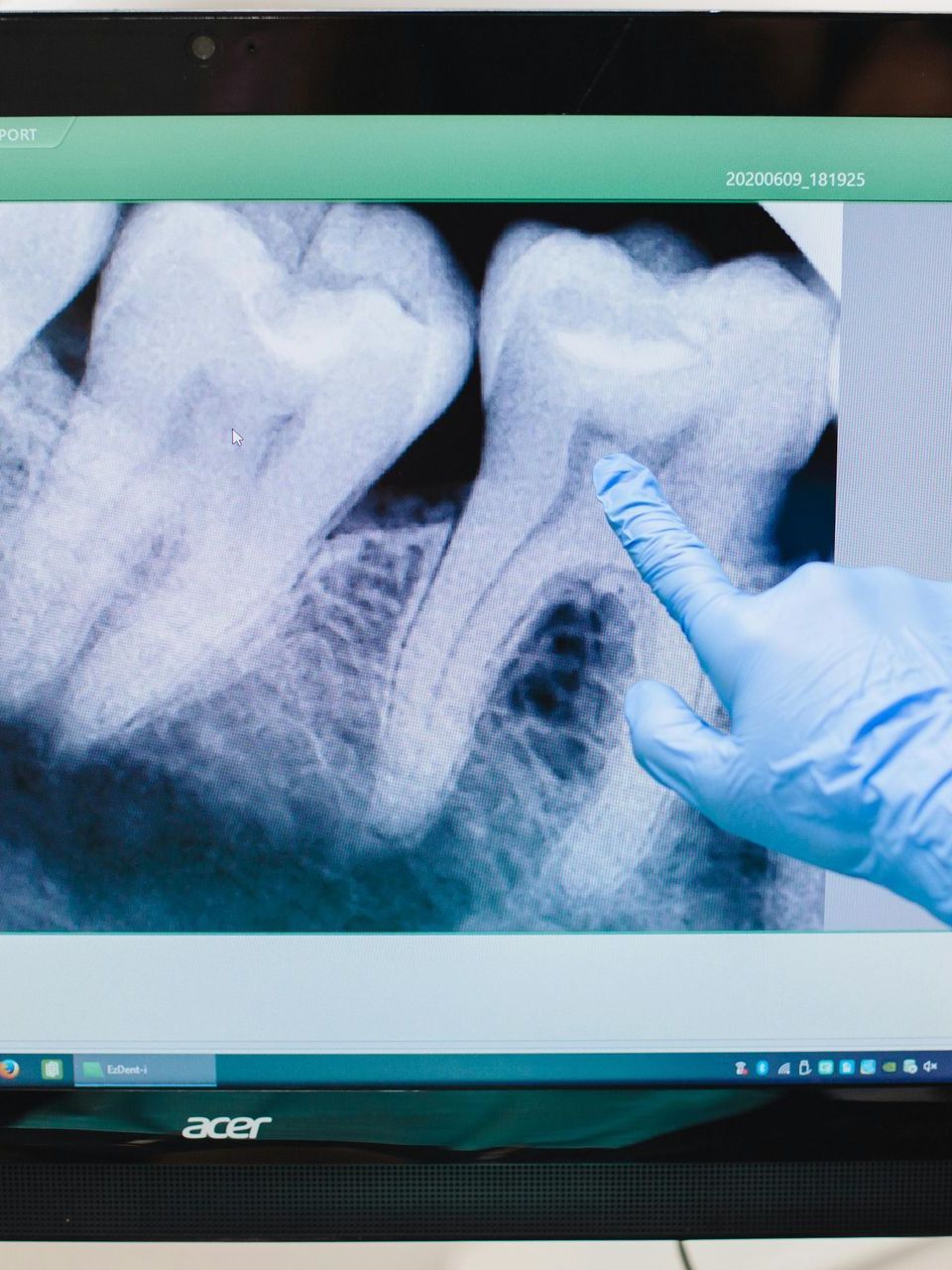 dentist pointing to tooth x-ray