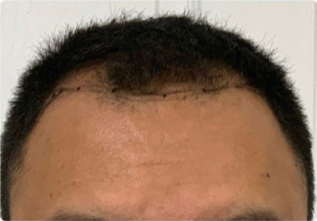 Two images: top showing receding hairline, bottom showing fuller hairline.
